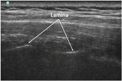 �T�Ғ���ۯ�,retrolaminar block,paravertebral block,�ŋ|��