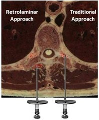 �T�Ғ���ۯ�,retrolaminar block,paravertebral block,�ŋ|��